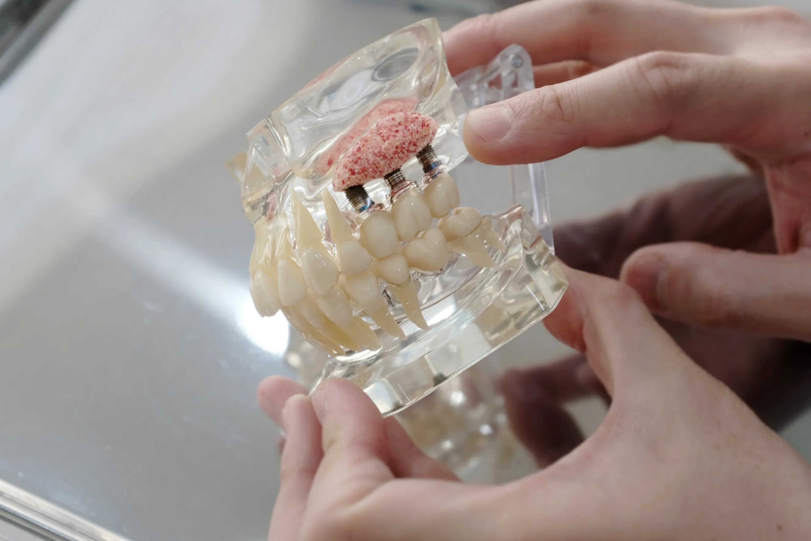 Bone Grafting