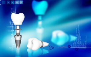 Get Smart About Implant Terminology