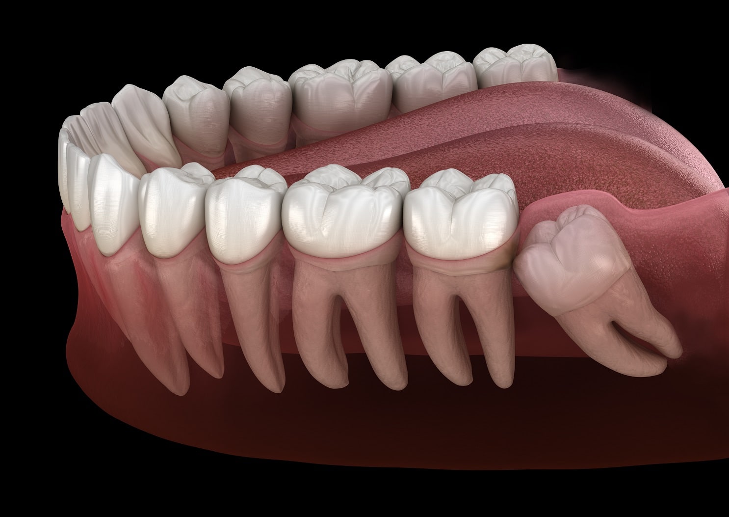 A Brief Look at Wisdom Teeth | Santa Rosa Oral Surgery