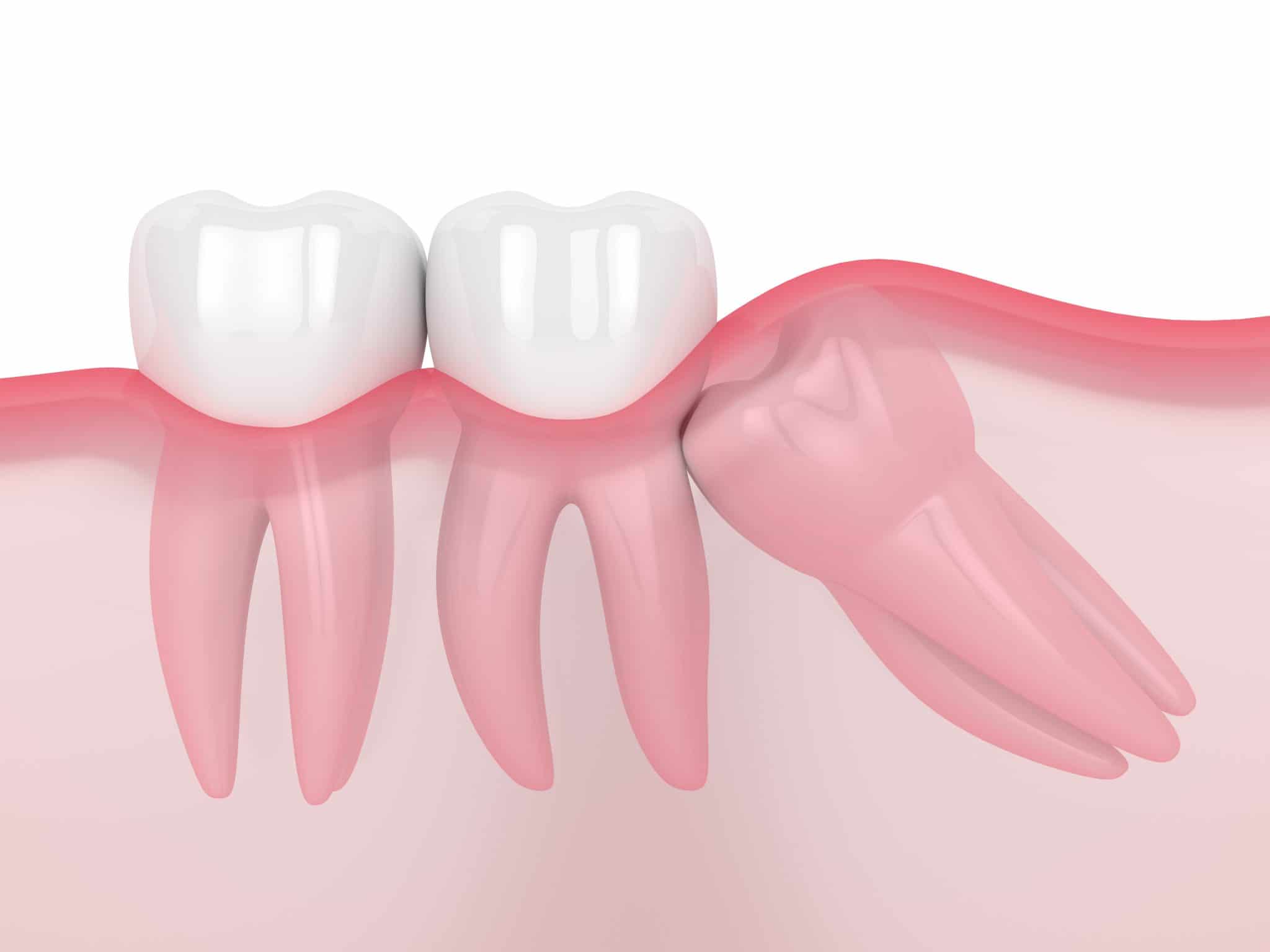 the-results-of-postponing-wisdom-tooth-extraction-santa-rosa