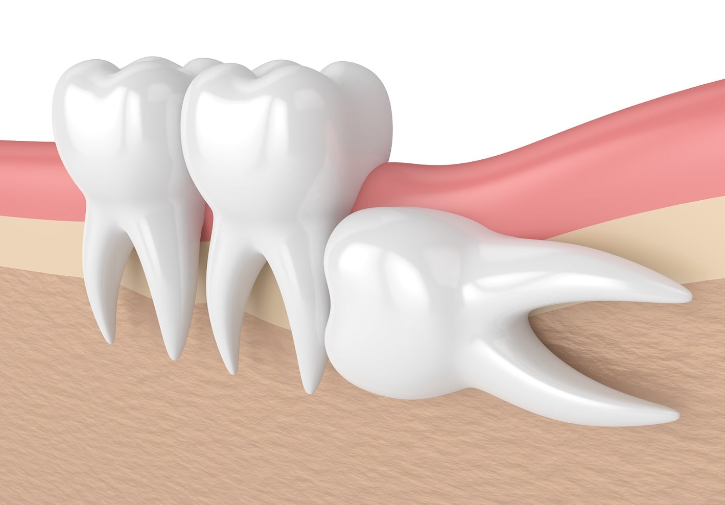 How Extracting Wisdom Teeth Improves Your Oral Health Santa Rosa Oral 