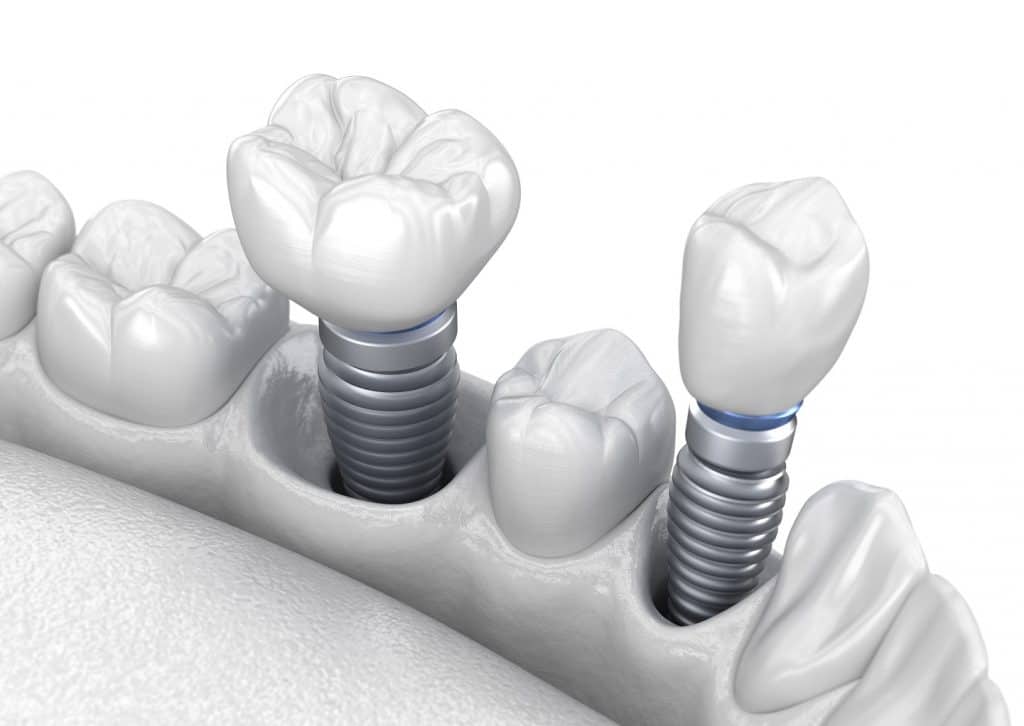 Factors that Impact Your Dental Implant Placement | Santa Rosa Oral Surgery