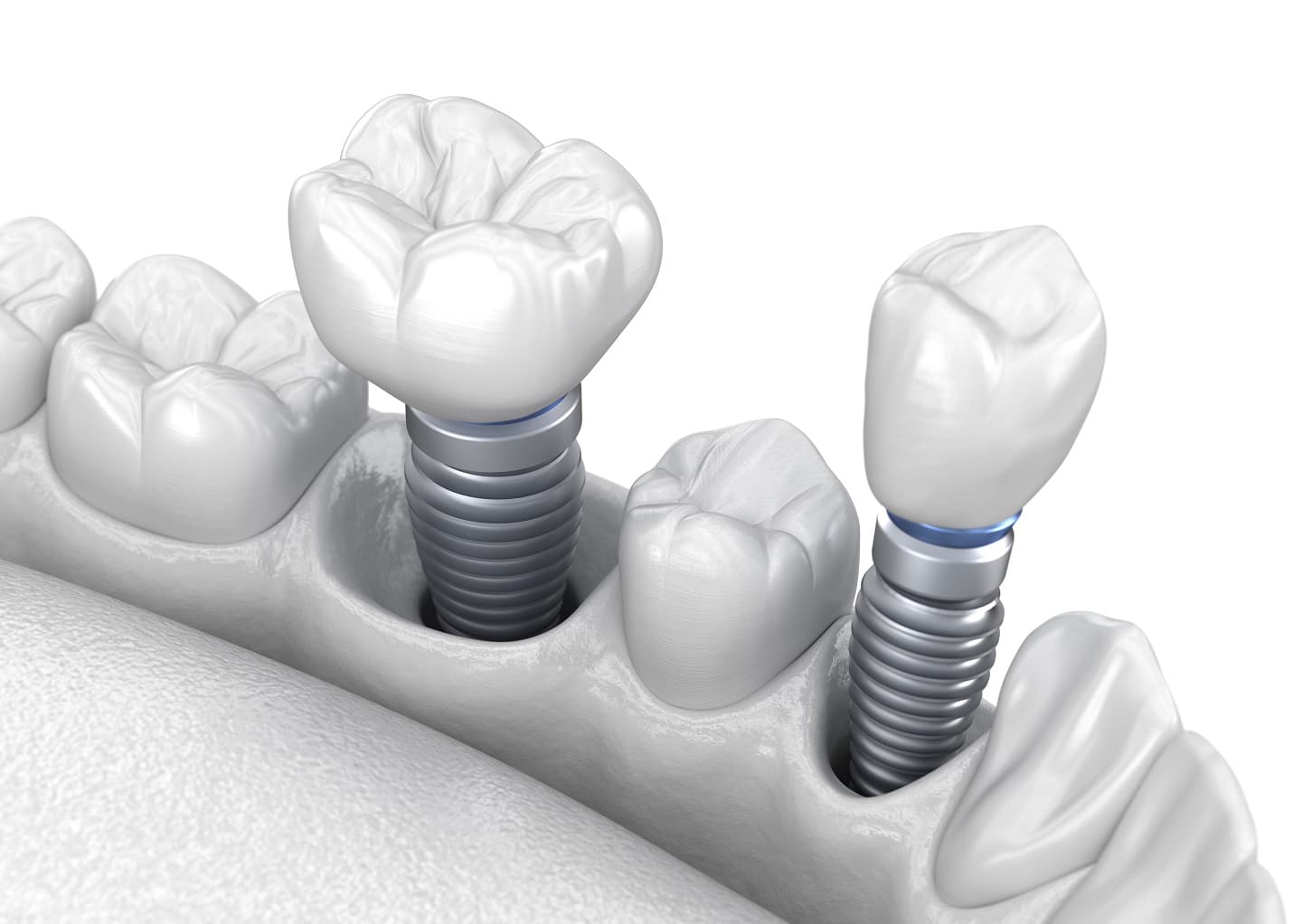 Factors that Impact Your Dental Implant Placement | Santa Rosa Oral Surgery