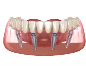 Santa Rosa All-On-Four Treatment