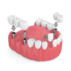 3d render of jaw with dental implants and bridges over white background