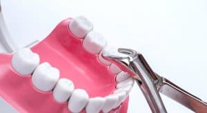 wisdom tooth removal santa rosa