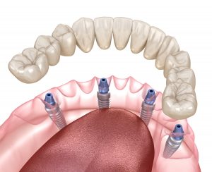 santa rosa implant dentures