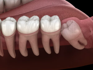 santa rosa impacted teeth