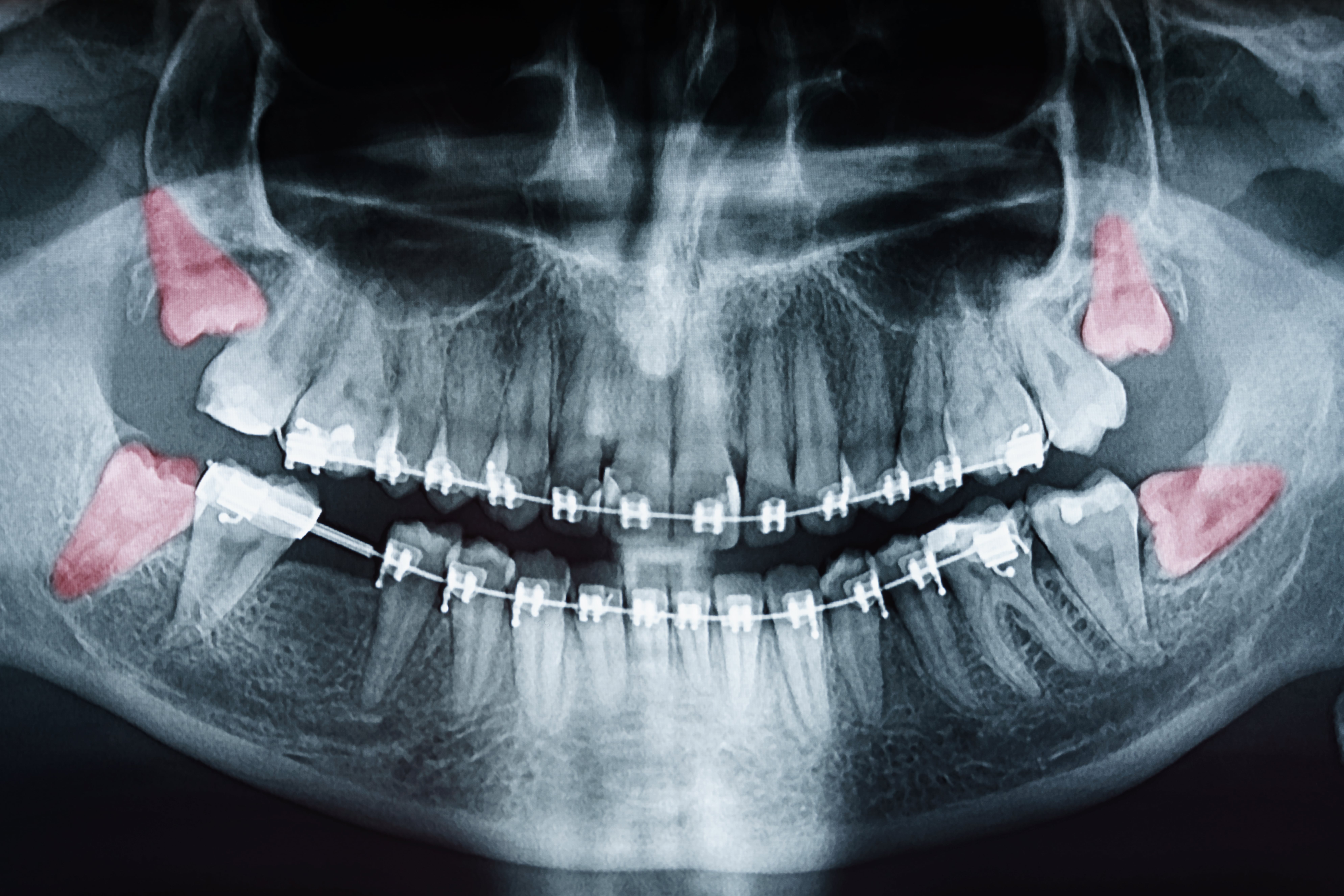 Santa Rosa Oral Surgeons Don't Want Wisdom Teeth To Harm Smiles