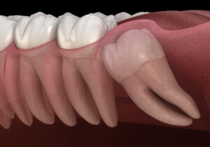 santa rosa impacted teeth