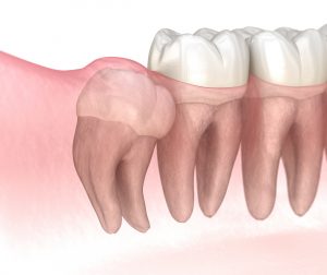 santa rosa impacted tooth