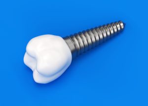 santa rosa dental implants