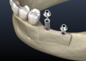 santa rosa jawbone grafting