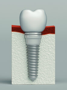 santa rosa dental implant