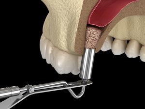 santa rosa bone grafting