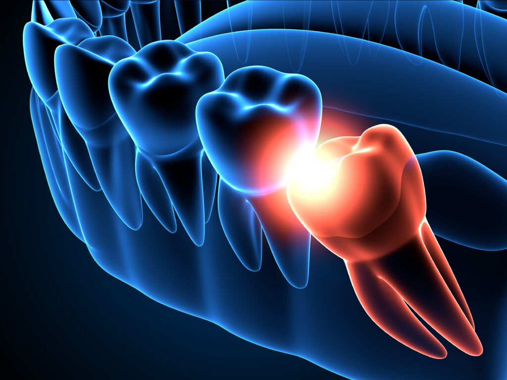 santa rosa extract wisdom teeth