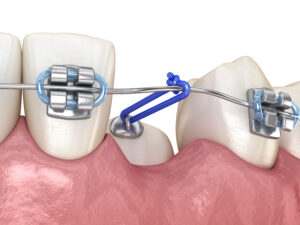 santa rosa impacted teeth