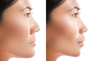 santa rosa jaw surgery