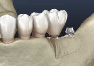 santa rosa jawbone grafting