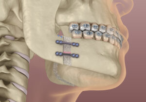 santa rosa jaw surgery