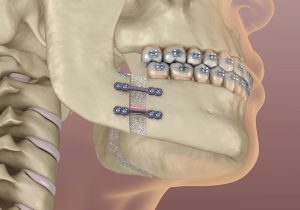 santa rosa jaw surgery