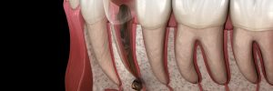 santa rosa tooth extraction