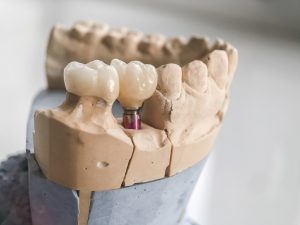 santa rosa dental implants