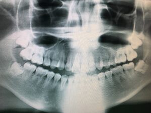 santa rosa jaw surgery