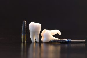 santa rosa extractions for implants