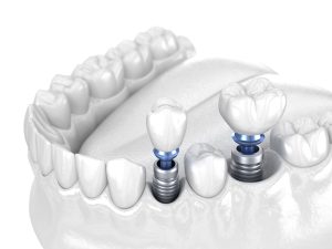 santa rosa dental implants