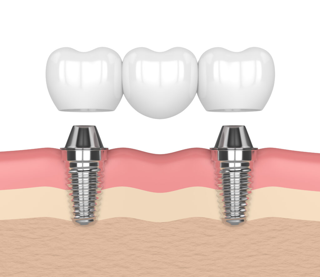 santa rosa oral surgery recovery