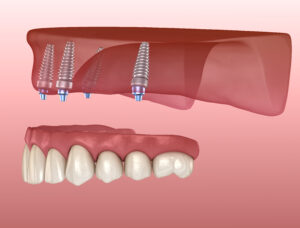 Santa Rosa all on four implants