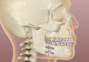 santa rosa jaw surgery