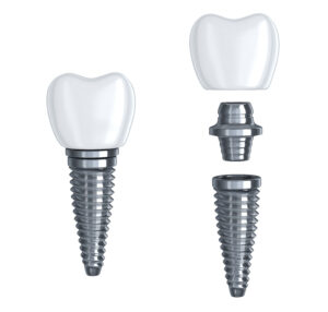 Santa Rosa dental implant parts