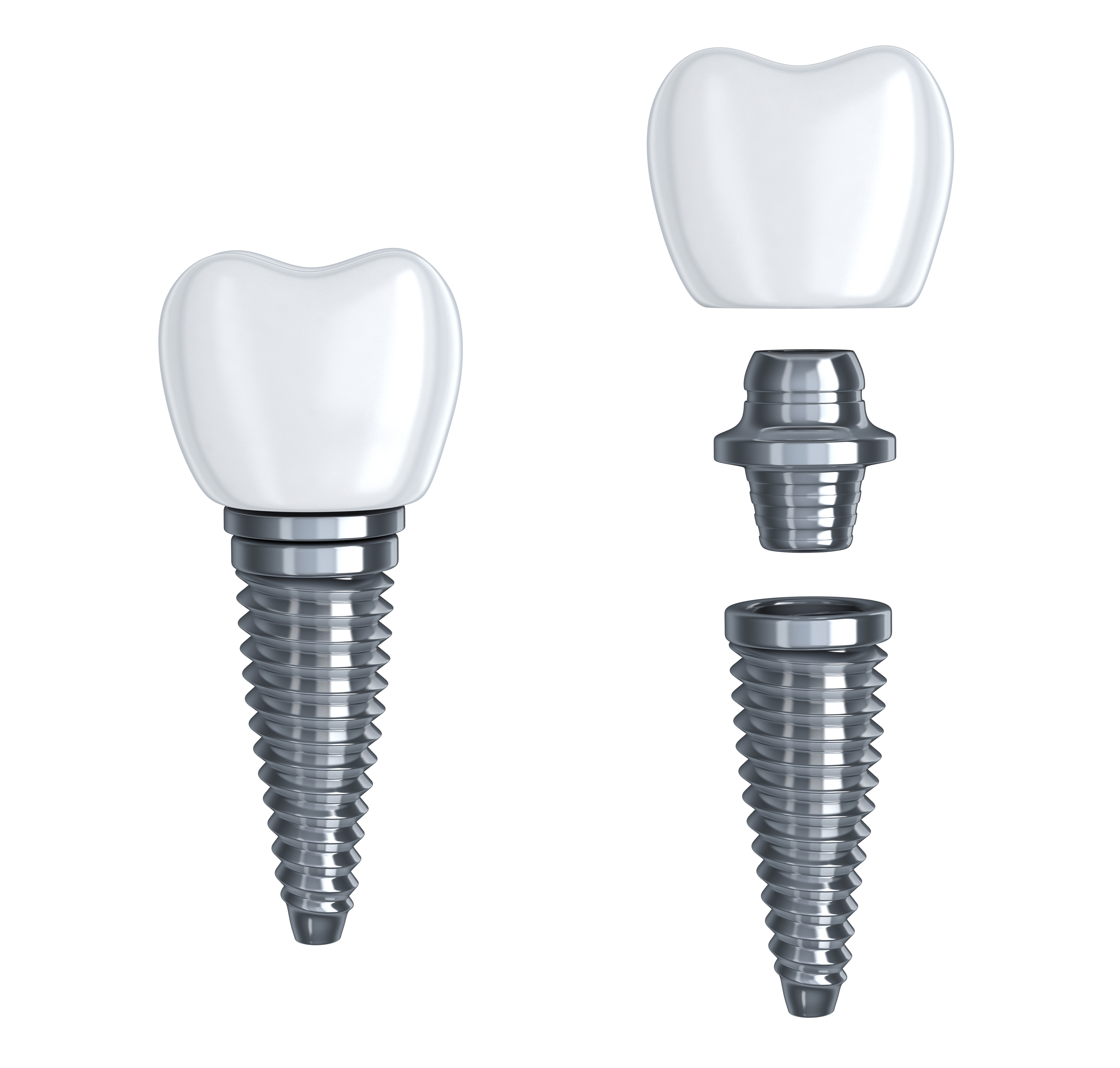 What Makes Up A Dental Implant? | Santa Rosa Oral Surgery