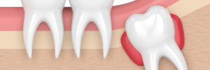 Santa Rosa tooth extraction