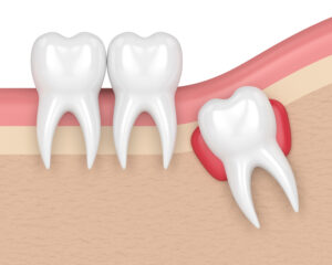 Santa Rosa tooth extraction