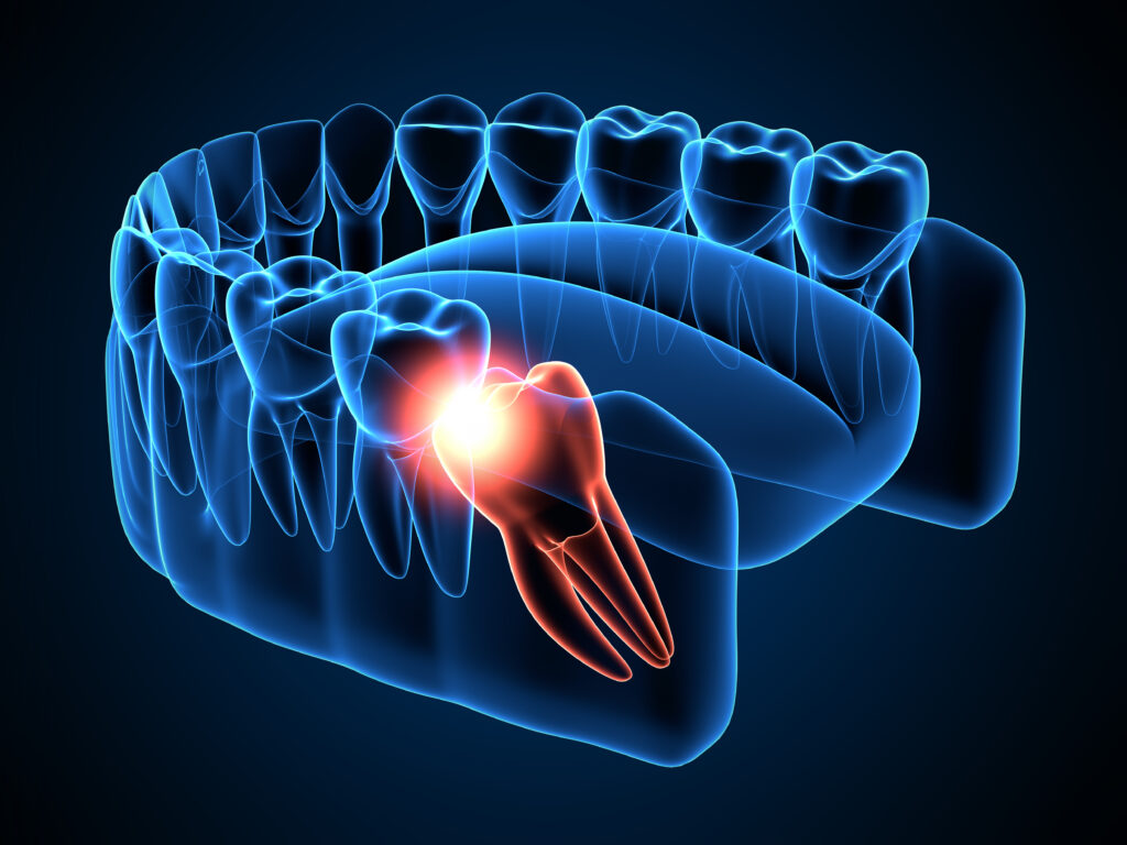 santa rosa wisdom tooth