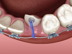 santa rosa bracketed teeth