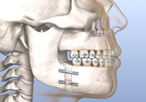 santa rosa orthognathic surgery