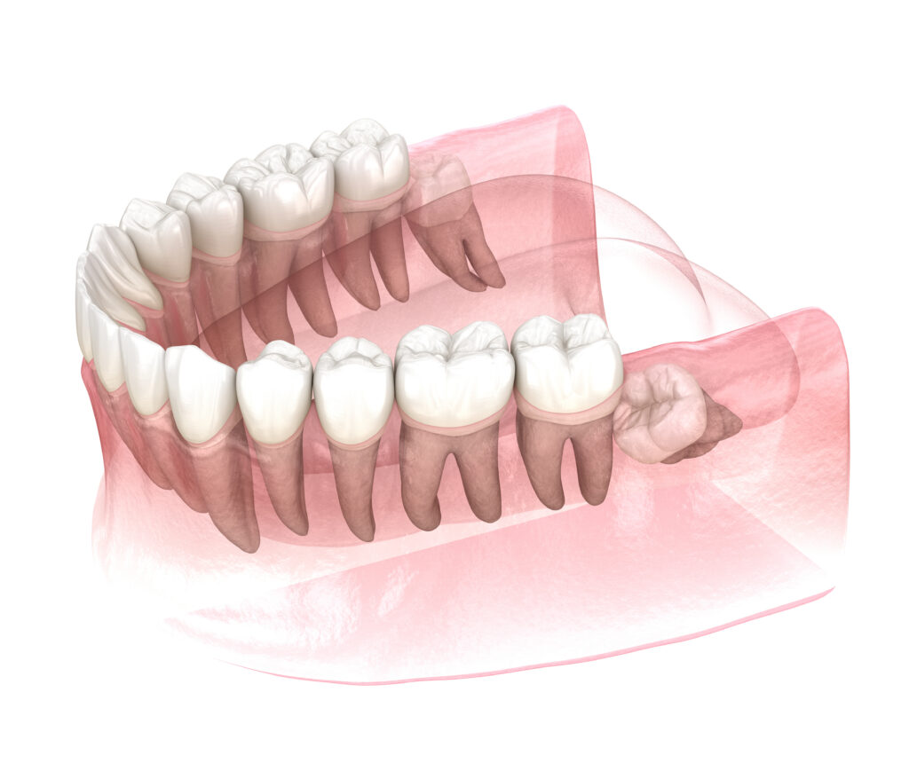 santa rosa wisdom tooth