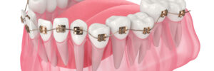 santa rosa bracketing teeth