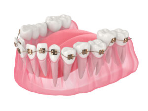 santa rosa bracketing teeth