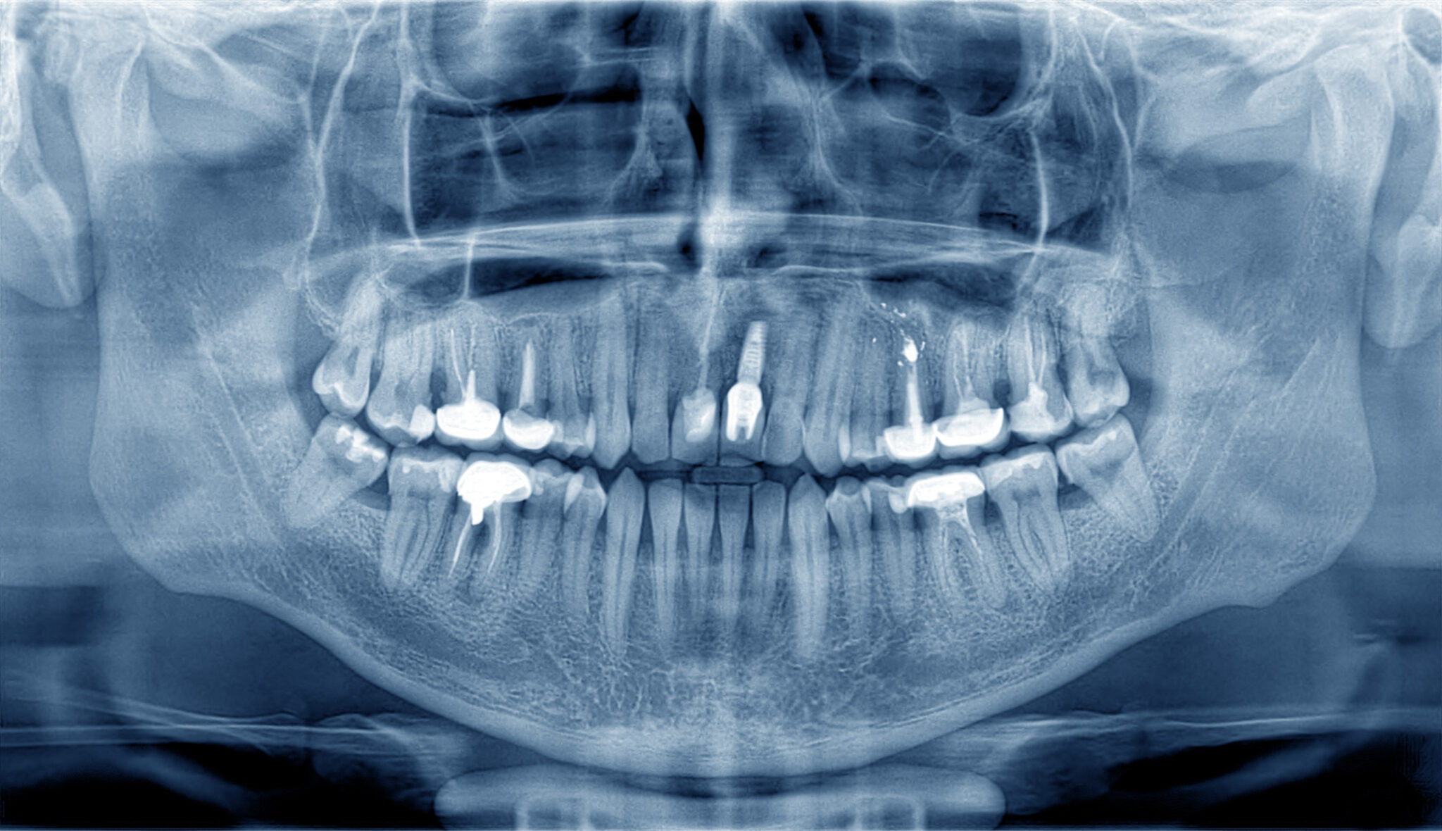 Planning Surgery With Digital Imaging | Santa Rosa Oral Surgery