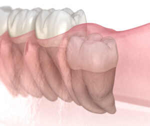 santa rosa wisdom teeth