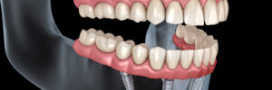rohnert park implant dentures