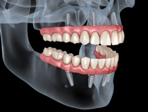 rohnert park implant dentures