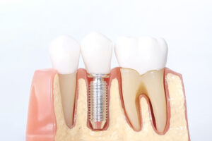 santa rosa dental implants