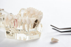 santa rosa dental implants