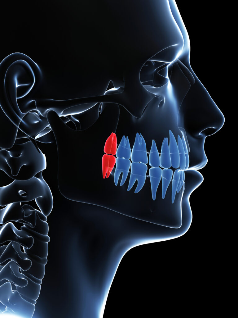 wisdom tooth extraction rohnert park